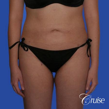 best full body liposuction abdomen flanks thighs knees - After Image