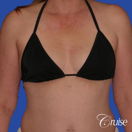 Breast Augmentation - Before and After Image 3
