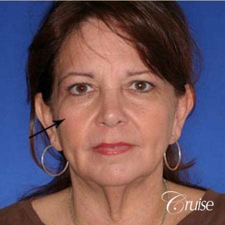great female fat transfer results newport beach - Before Image