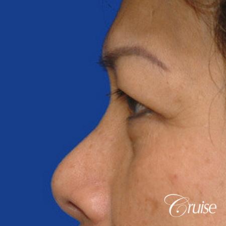 best Asian Upper eye lid plastic surgeon Newport Beach - Before Image 2