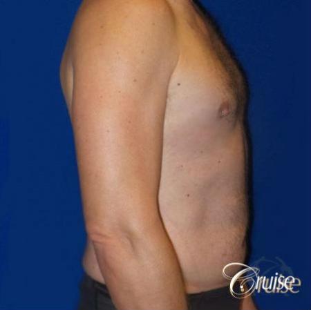Best Gynecomastia surgeons Los Angeles - After Image 3