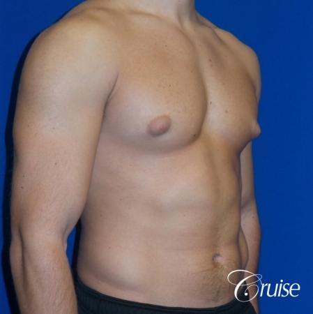 male breast reduction surgery newport beach - Before Image 2