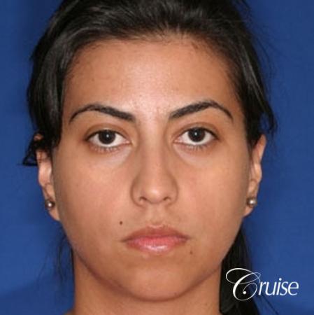 best XL chin implant on female patient - Before Image 1