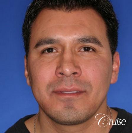chin augmentation orange county - After Image 1