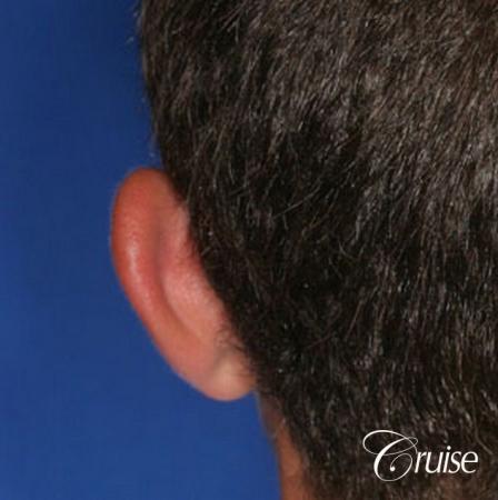best plastic surgeon eye pinning male newport beach - Before and After Image 3