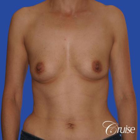 Breast Augmentation - Before Image 1