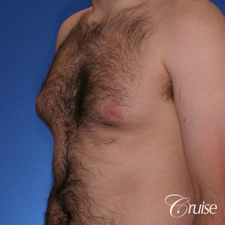 best Puffy nipple correction and gynecomastia on young adult - Before and After Image 3