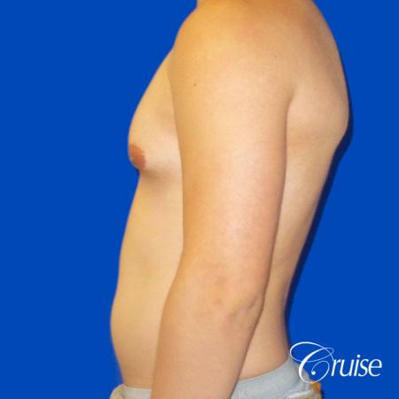 Best Gynecomastia surgeons Southern California - Before Image 2