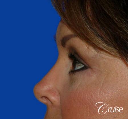 best blepharoplasty eye surgery photos - After Image 2