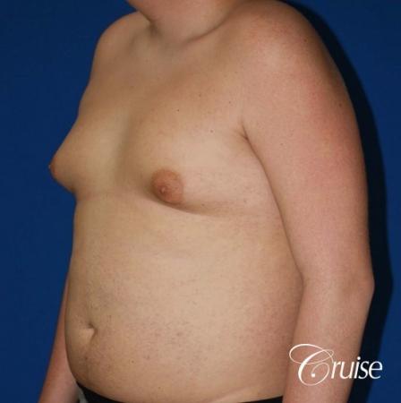 moderate gynecomastia with free nipple graft scar on teenager - Before Image 2