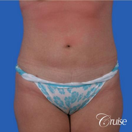 liposuction on abdomen photos - After Image 1