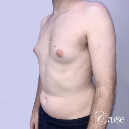 Gynecomastia: Patient 128 - Before 3