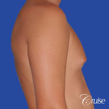 teen with pointy / puffy nipples get gynecomastia surgery - Before Image 3