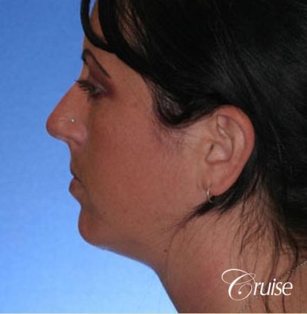 before and after photos of female chin implant - After Image 2