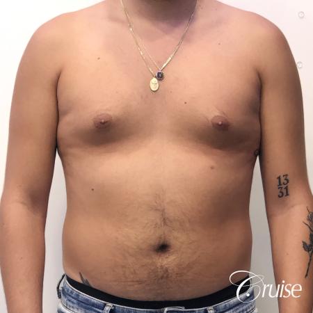 gynecomastia correction orange county - Before Image 1