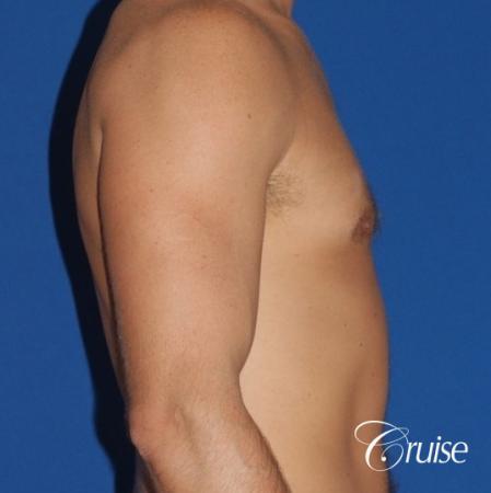 mild gyne on athletic adult - After Image 2