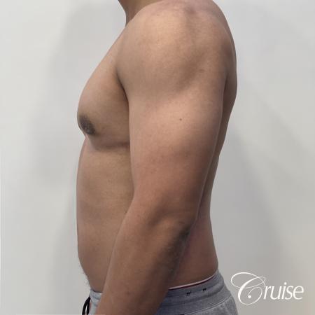 gynecomastia surgery - After 2