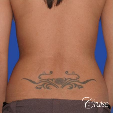 top plastic surgeon for liposuction in Newport Beach - Before and After Image 3
