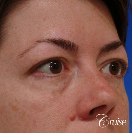 blepharoplasty specialist - Before Image 3