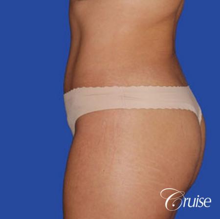 dramatic liposuction plastic surgeon does the best abdomen and flanks - After Image 2