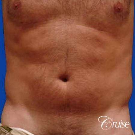 best male ab sculpting liposuction abdomen flanks - Before Image