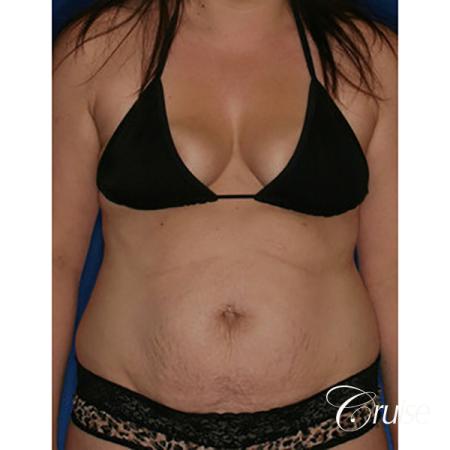best mommy makeover with saline breast implants - Before Image 5