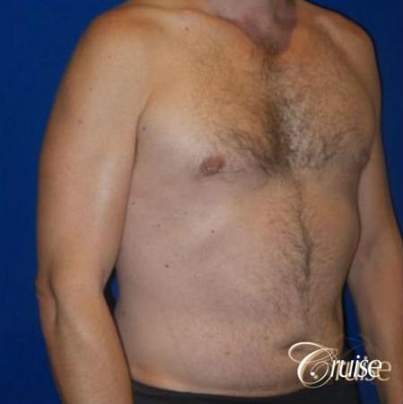 Best Gynecomastia surgeons Los Angeles - After Image 2
