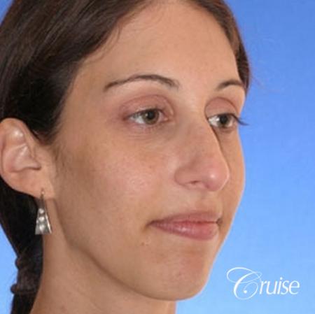 29 yr old with large female chin augmentation - Before and After Image 3