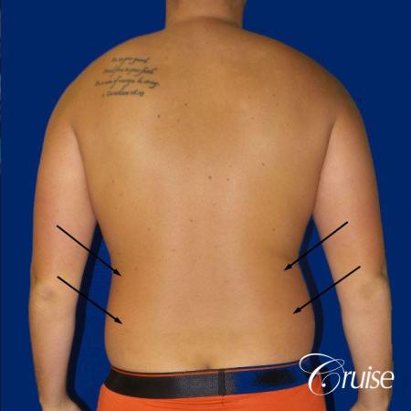 Best before and after lipo photos of guys - Before and After Image 4