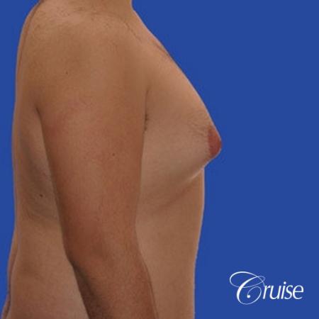 moderate gynecomastia with pointy nipples male - Before and After Image 4