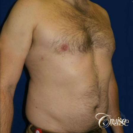 male breast reduction surgery - After Image 2