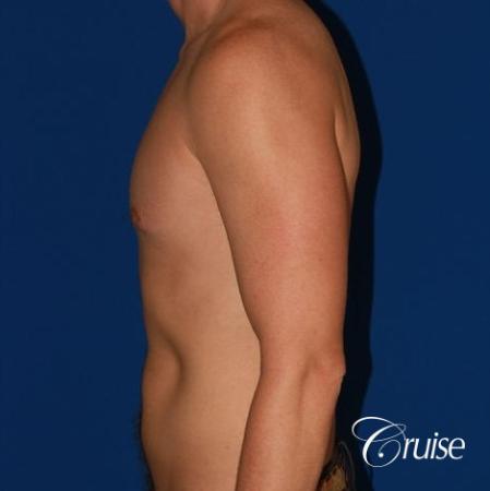 puffy nipple on low body fat - After Image 2