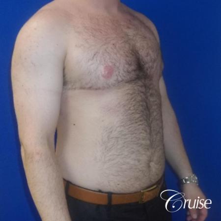 Severe Gynecomastia- Free nipple Graft - After Image 3