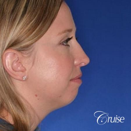 best plastic surgeon for chin augmentation implant - Before Image 2