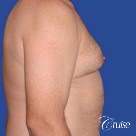 chest liposuction on adult - Before Image 3