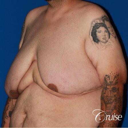 severe gynecomastia with free nipple graft on adult - Before and After Image 3