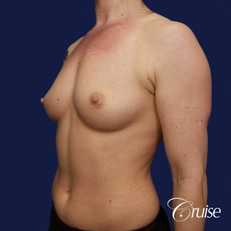 Breast Augmentation - Before and After 3