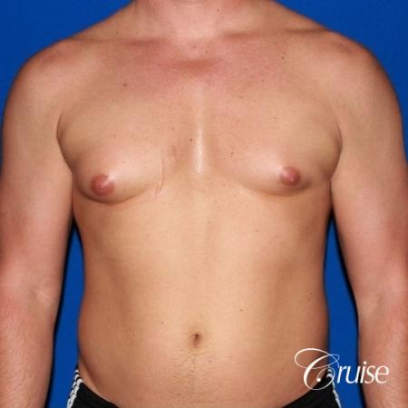 body builder with Gynecomastia puffy nipple - Before Image 1