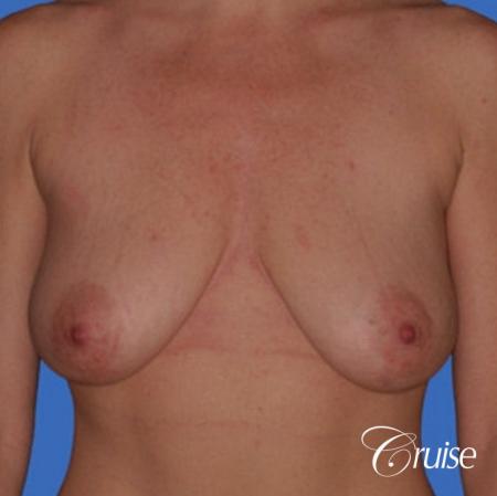 best breast reduction without implants - Before Image 1