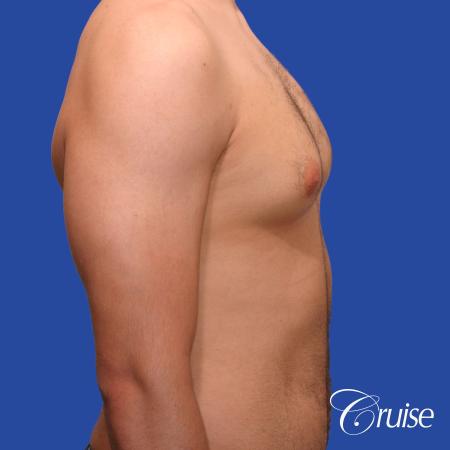 20 year old with moderate gynecomastia - Before and After Image 4