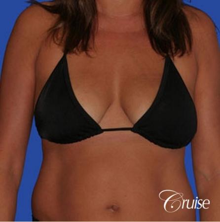 photos of best breast lift anchor with saline implants in Newport Beach - Before and After Image 3