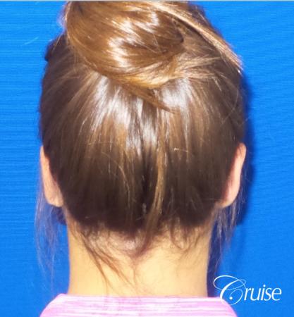 Otoplasty - After Image 3