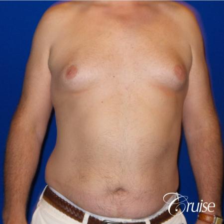 gynecomastia surgery results - Before Image 1