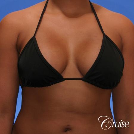Breast Augmentation - After Image 4