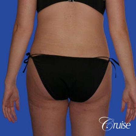 best pictures of liposuction with plastic surgeon in Newport Beach - After Image 1