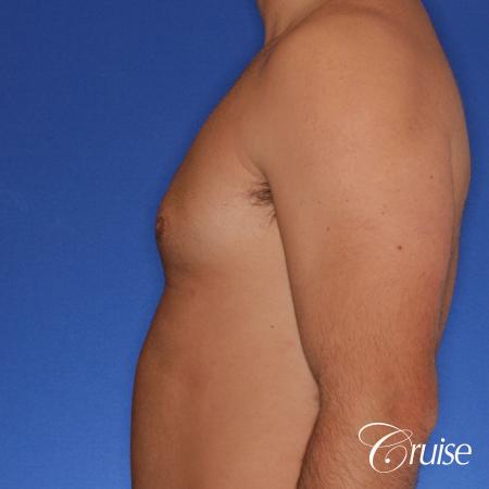male patient has mild gynecomastia - After Image 2
