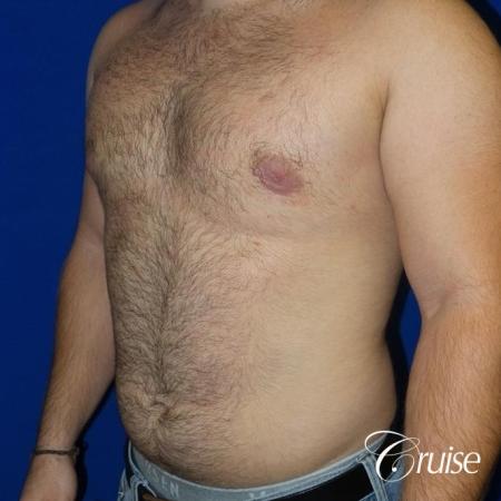 best gynecomastia results - After Image 2