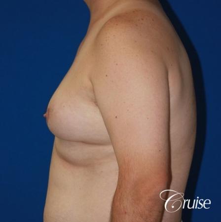 male breast severe gynecomastia free nipple graft anchor - Before Image 2