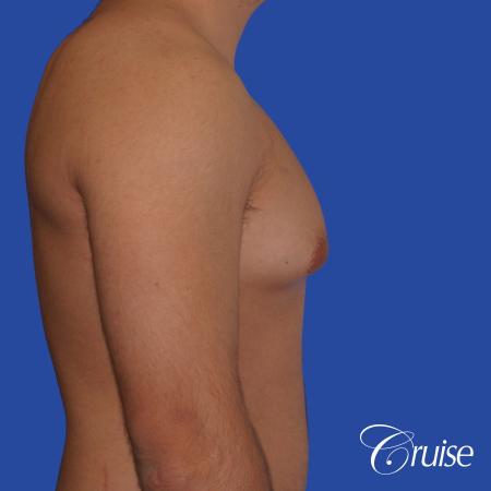 mild case of gynecomastia on adult - Before and After Image 3