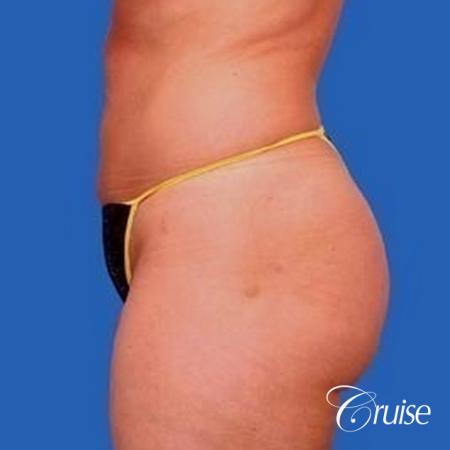 best liposuction abdomen, flanks and thighs - After Image 2